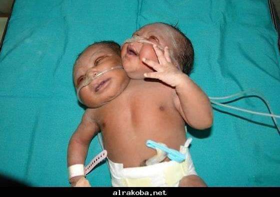 ولادة طفلة برأسين في مستشفى سوبا