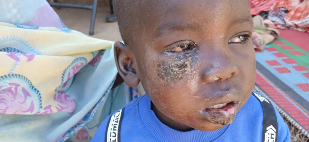 غرفة طوارئ قولو بجبل مرة: وفاة ٦ أطفال وإصابة ٣٠٠ بالحصبة في منطقة بوري وقرى مجاورة